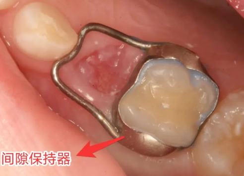 关于儿童乳牙龋齿（蛀牙）的一些常见问题