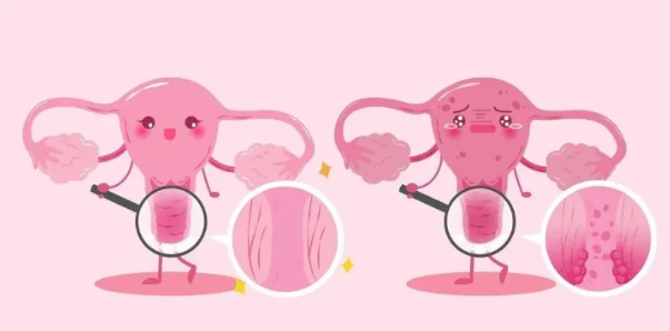 无症状却致癌？这种病毒正在威胁女性同胞