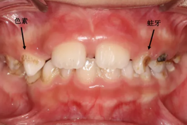 宝宝的牙齿为什么会发黑呢？
