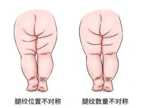 臀纹不对称一定是髋关节发育不良吗？