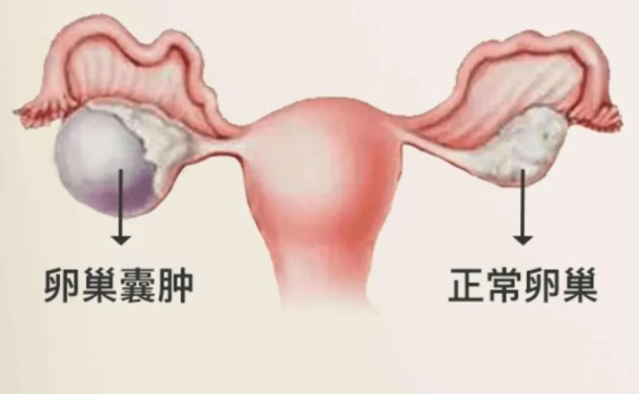 带您了解卵巢囊肿