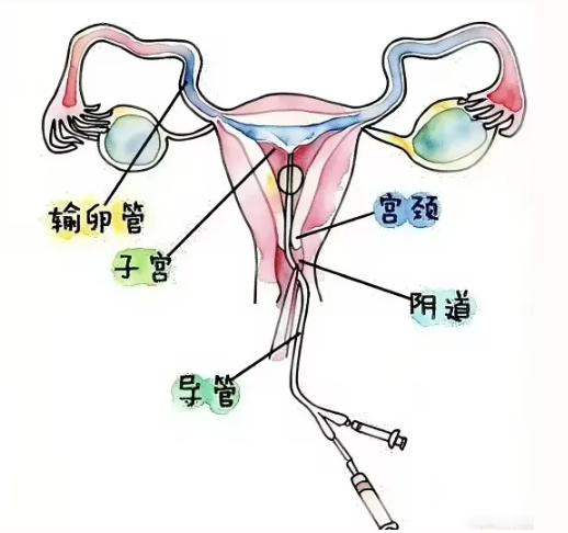 带您了解输卵管造影术